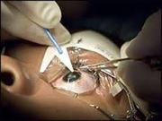Vitreo Retinal Surgeon
