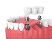 best implant dentist in chennai - akeela dental care